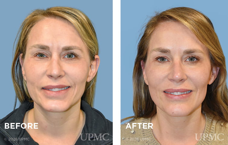 Patient had DAO resection for right facial synkinesis due to Lyme disease.